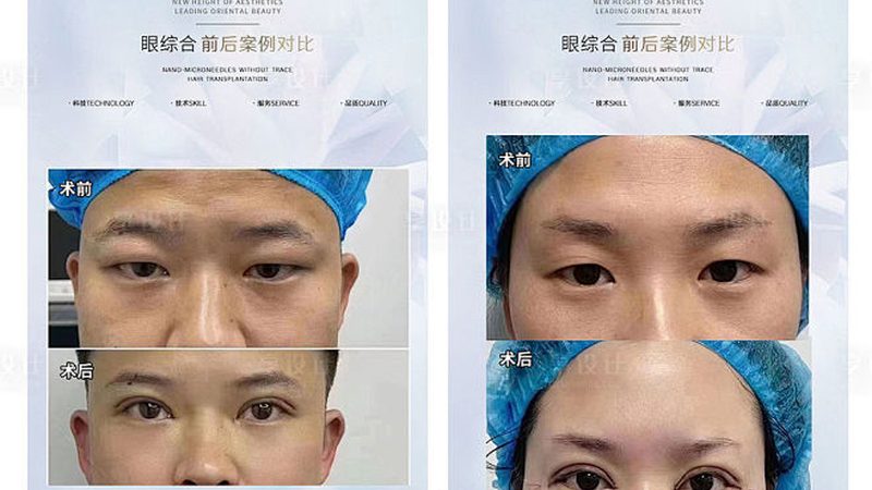 全身激光脱毛，2025年你不得不知的价格秘密