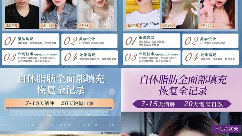 PPDO线埋线提升与线雕：揭秘两者间的差异与选择要点