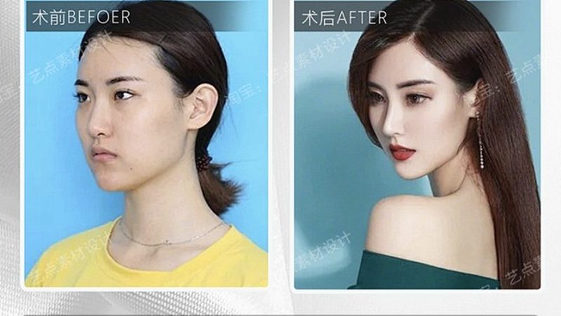 双眼皮手术：揭秘哪种方法更自然