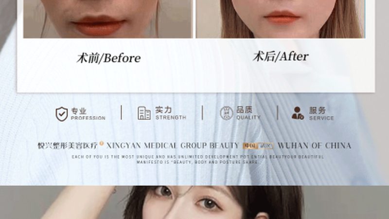 肉毒素注射后见效时间揭秘：揭秘注射流程与注意事项