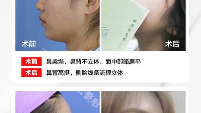蛋白线与普通线：材质差异与美容效果解析