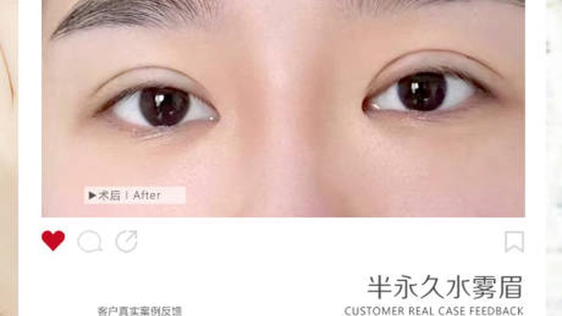 贴双眼皮贴三年，眼皮松弛了？揭秘双眼皮贴的潜在风险
