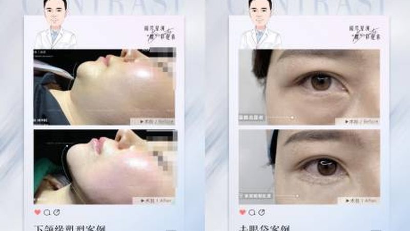 硅胶隆鼻取出后，恢复期的时间长短受到多个因素的影响。以下是一些关键因素：