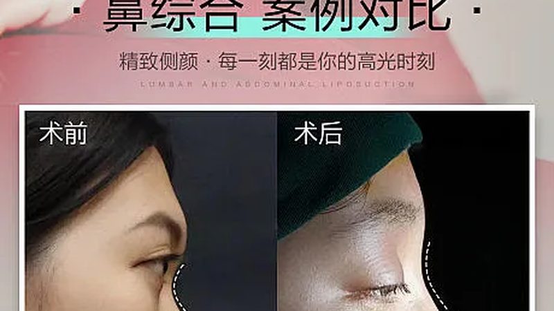 超声炮与热玛吉：揭秘美容界的双剑客**